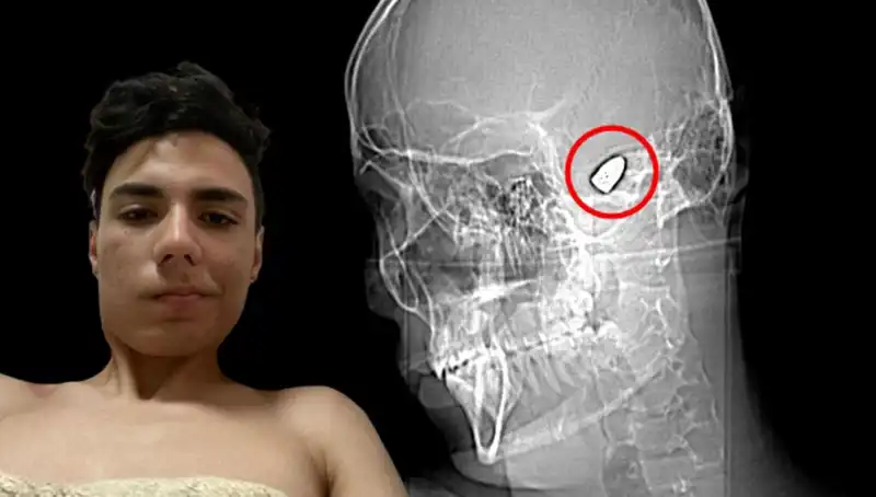Kafasında Patlamaya Hazır Bomba Taşıyan Genç: Hayat Mücadelesi